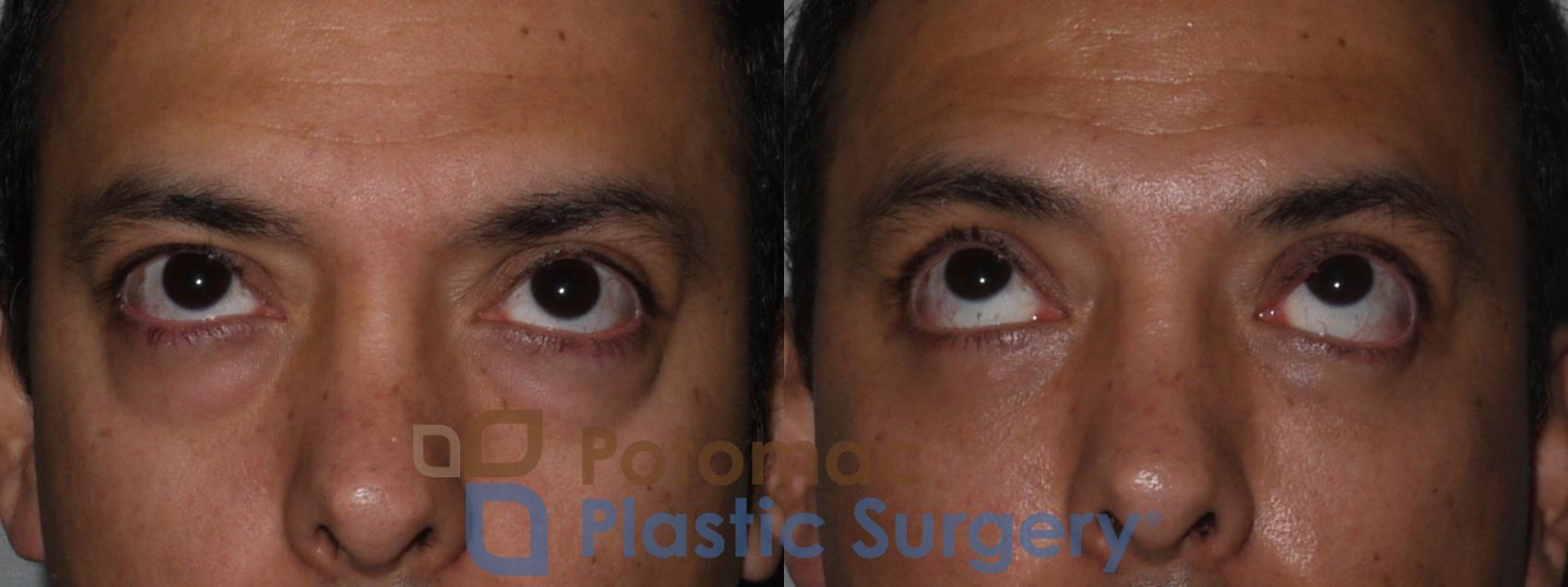 Before & After Blepharoplasty Case 117 Front View #2 View in Washington, DC