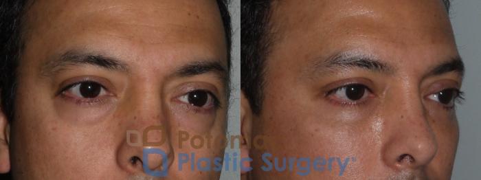 Before & After Blepharoplasty Case 117 Right Oblique View in Washington, DC