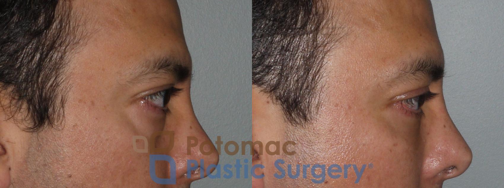 Before & After Blepharoplasty Case 117 Right Side View in Washington, DC