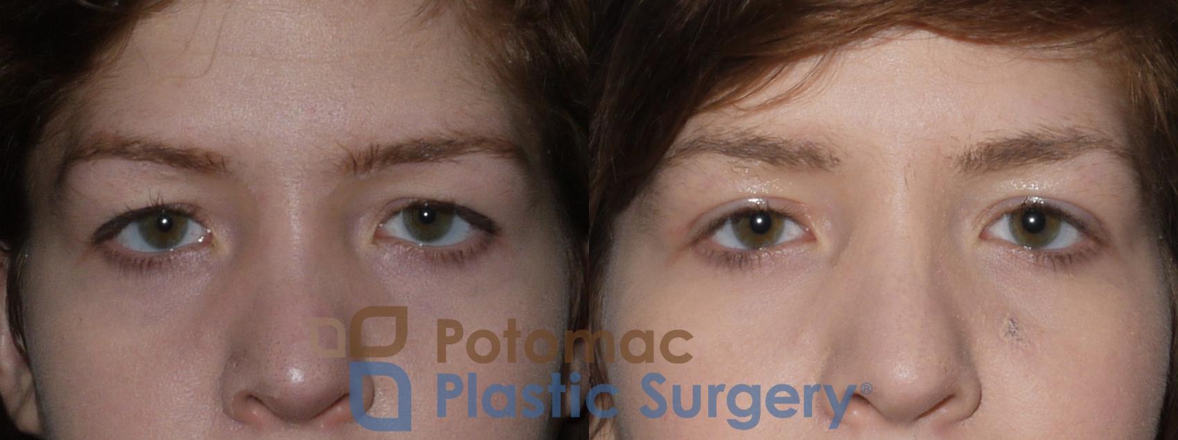 Before & After Blepharoplasty Case 120 Front View in Washington, DC