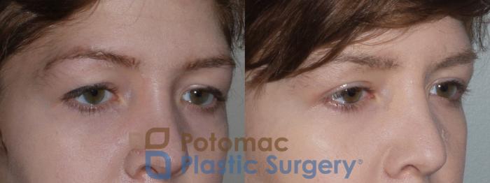 Before & After Blepharoplasty Case 120 Right Oblique View in Washington, DC