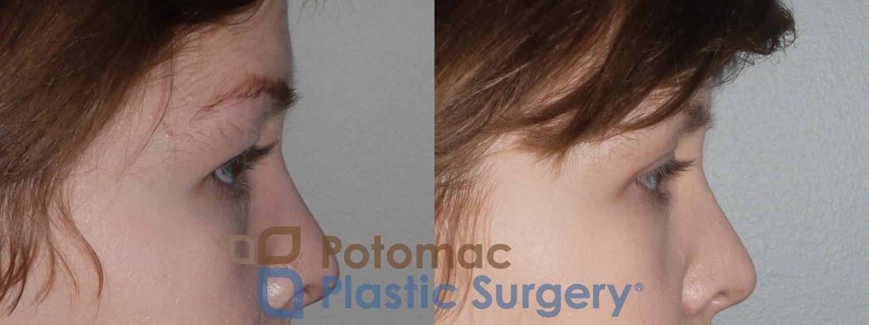 Before & After Blepharoplasty Case 120 Right Side View in Washington, DC