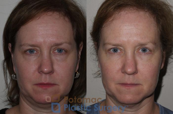Before & After Blepharoplasty Case 125 Front View in Washington DC & Arlington , DC