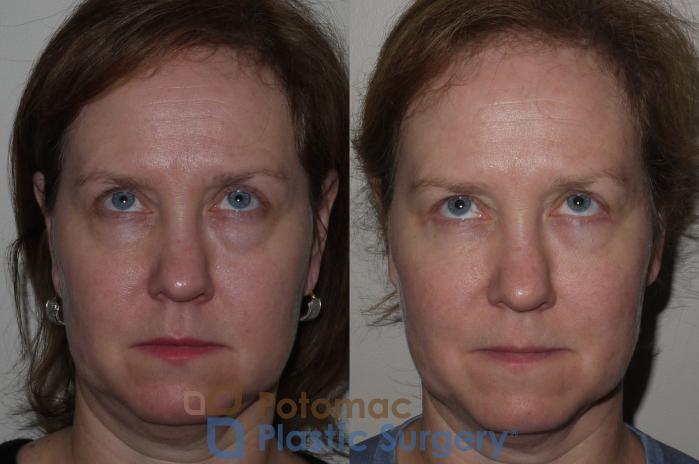 Before & After Blepharoplasty Case 125 Front View #2 View in Washington DC & Arlington , DC
