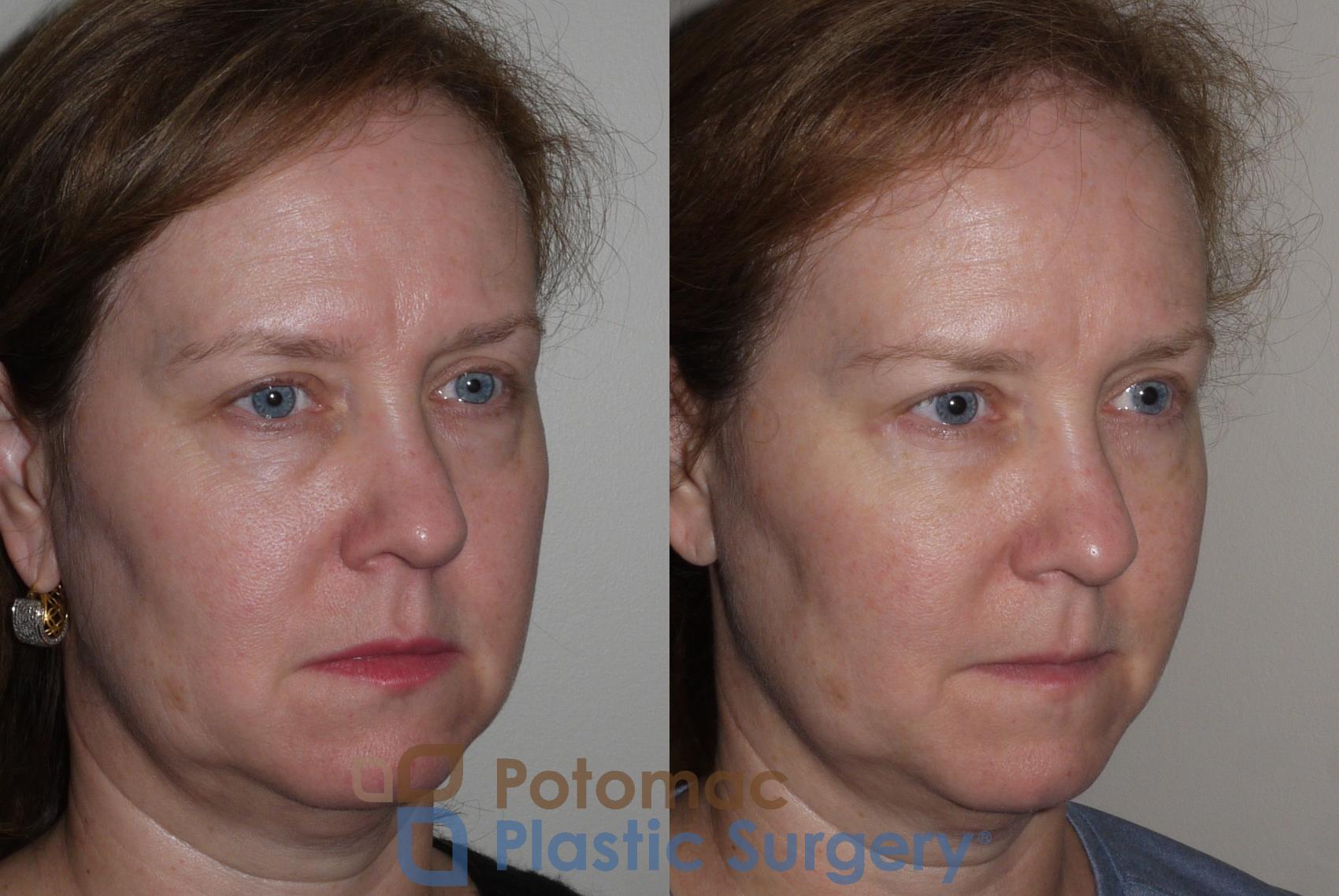 Before & After Blepharoplasty (Eyelid Surgery) Case 125 Right Oblique View in Washington DC & Arlington , DC
