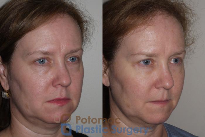 Before & After Blepharoplasty Case 125 Right Oblique View in Washington DC & Arlington , DC