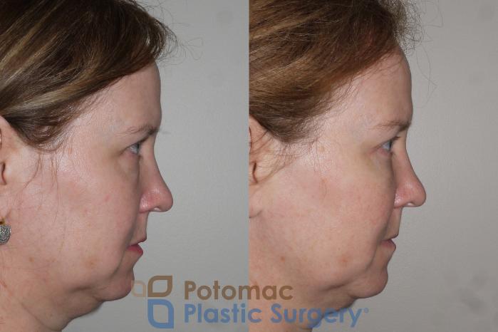 Before & After Blepharoplasty Case 125 Right Side View in Washington DC & Arlington , DC