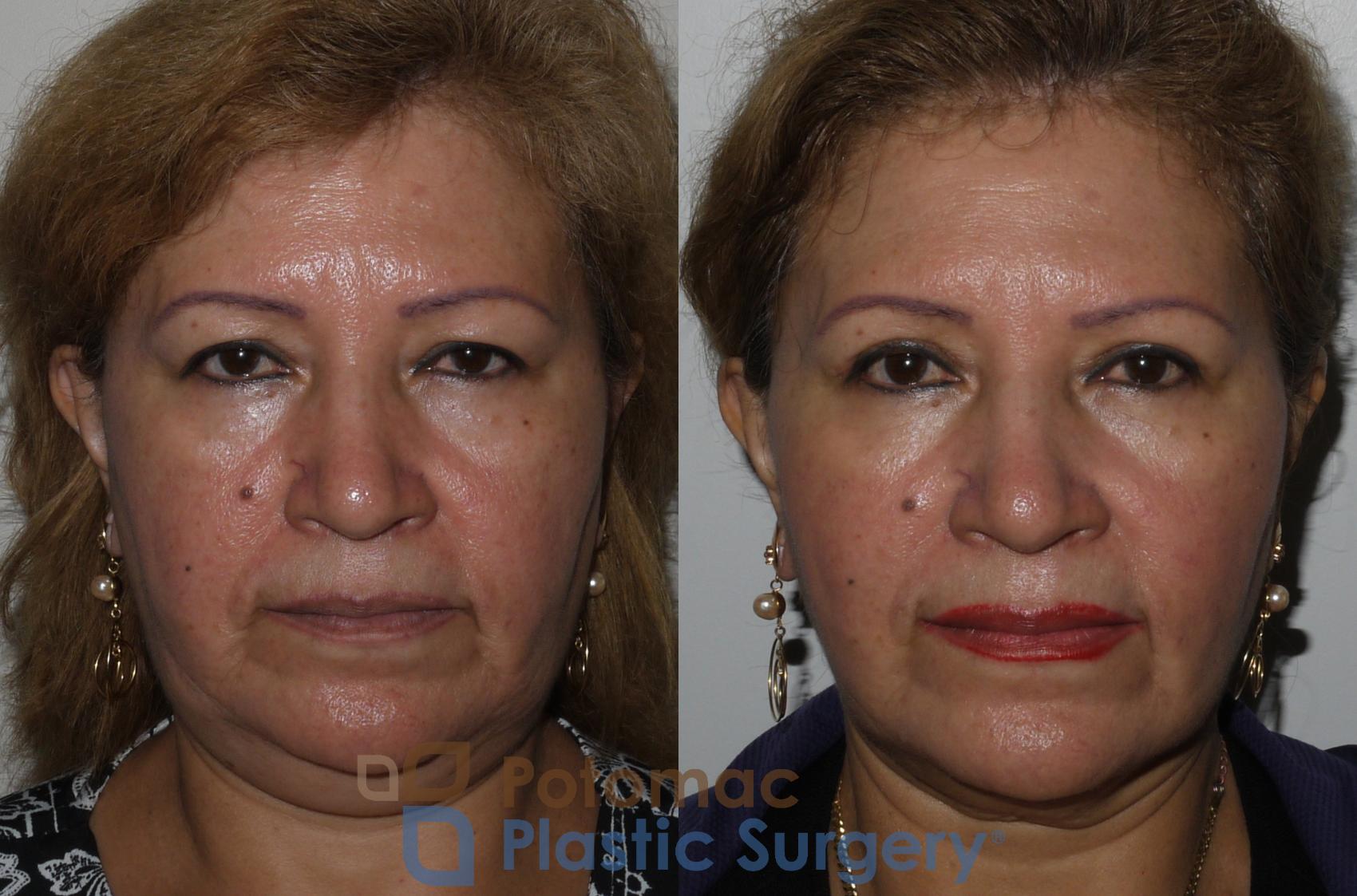 Before & After Blepharoplasty Case 134 Front View in Washington, DC