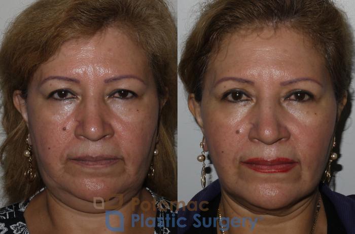 Before & After Blepharoplasty Case 134 Front View in Washington, DC