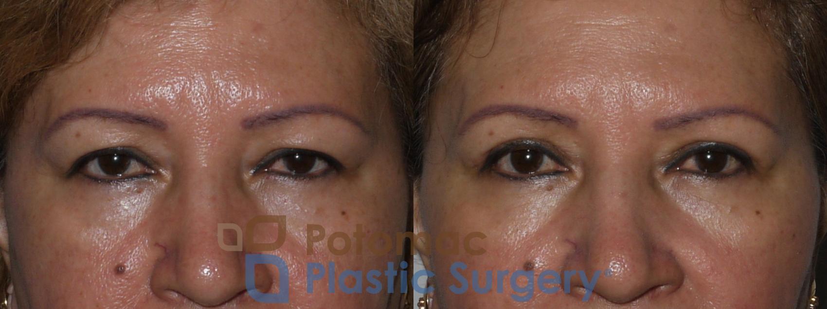 Before & After Blepharoplasty Case 134 Front View #2 View in Washington, DC