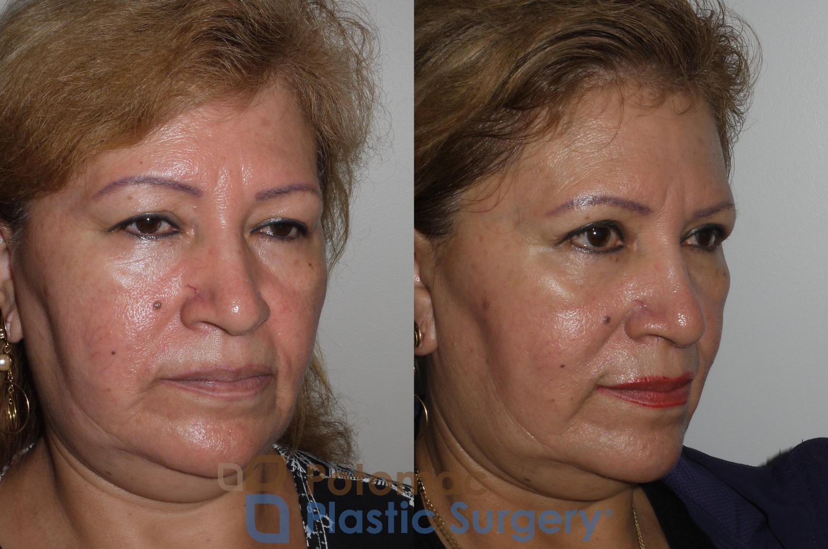 Before & After Blepharoplasty Case 134 Right Oblique View in Washington, DC