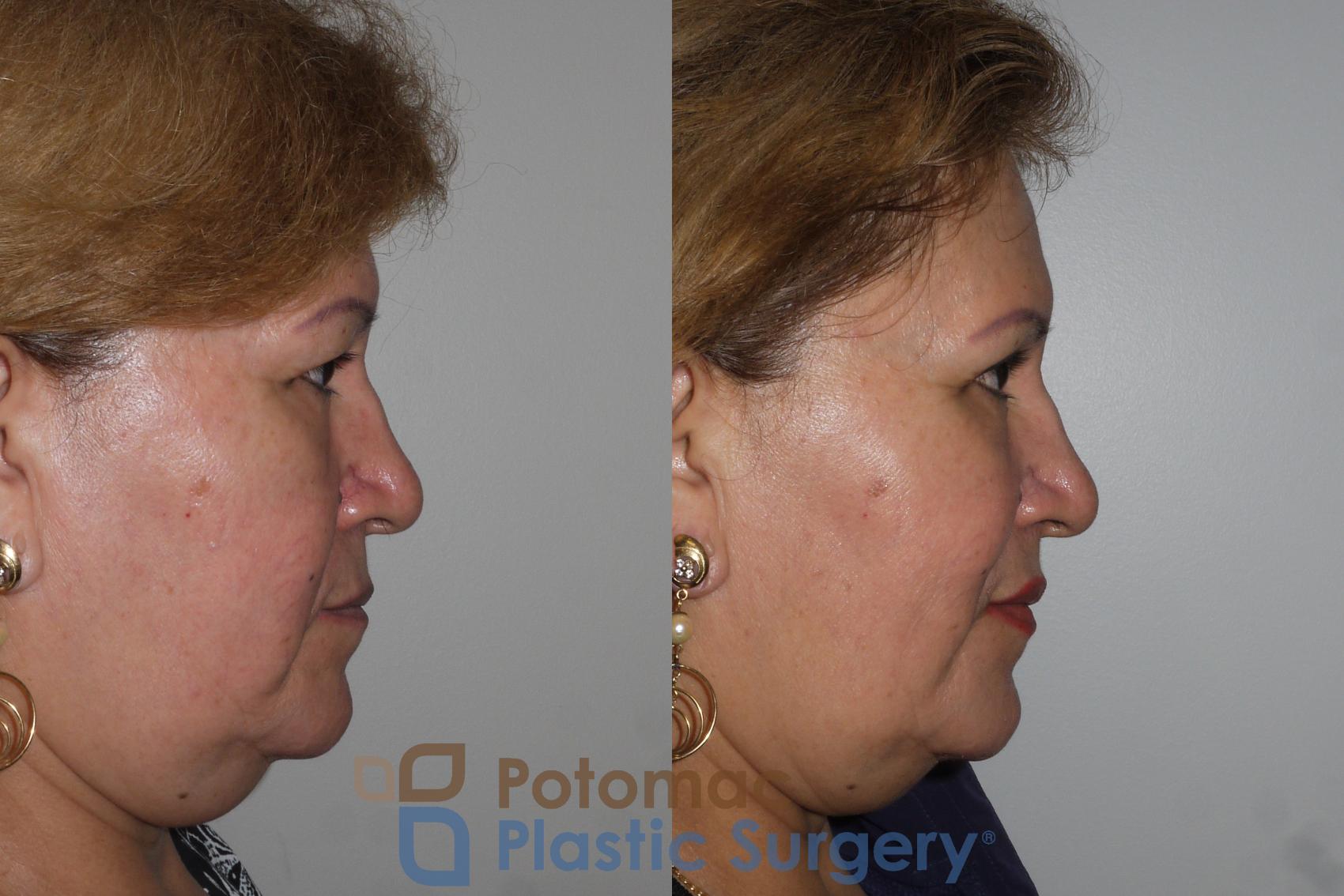 Before & After Blepharoplasty Case 134 Right Side View in Washington, DC