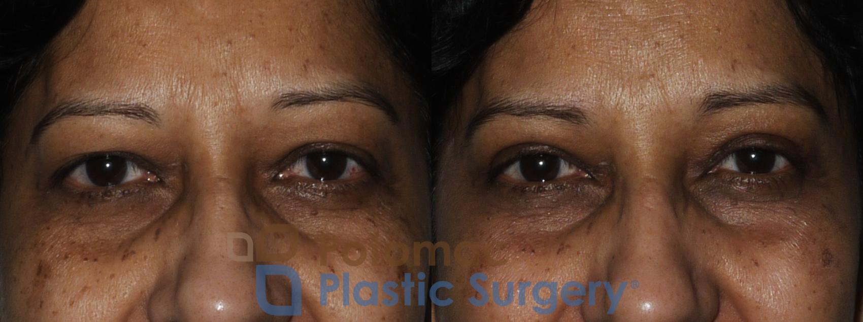 Before & After Blepharoplasty Case 173 Front View #1 View in Washington, DC
