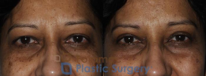 Before & After Blepharoplasty Case 173 Front View #1 View in Washington DC & Arlington , DC
