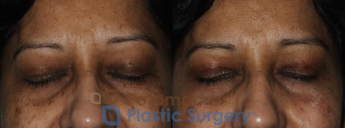 Before & After Blepharoplasty Case 173 Front View #2 View in Washington DC & Arlington , DC