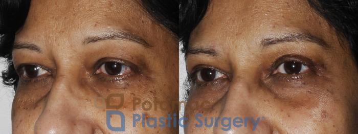 Before & After Blepharoplasty Case 173 Left Oblique View in Washington DC & Arlington , DC