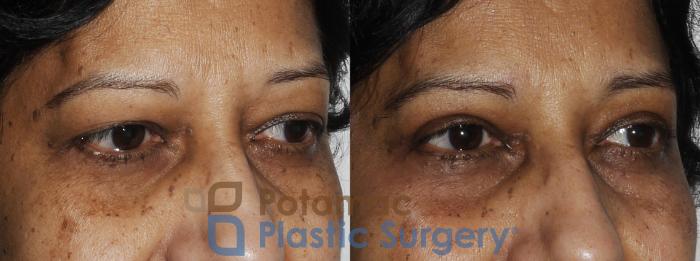 Before & After Blepharoplasty Case 173 Right Oblique View in Washington DC & Arlington , DC