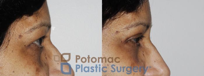 Before & After Blepharoplasty Case 173 Right Side View in Washington DC & Arlington , DC