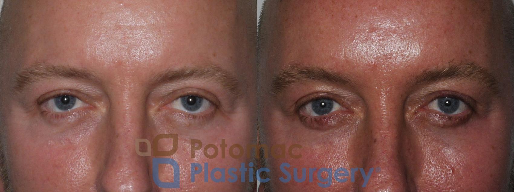Before & After Blepharoplasty Case 178 Front View in Washington, DC