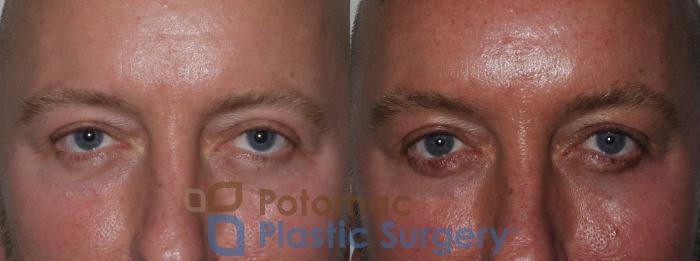 Before & After Blepharoplasty Case 178 Front View in Washington, DC