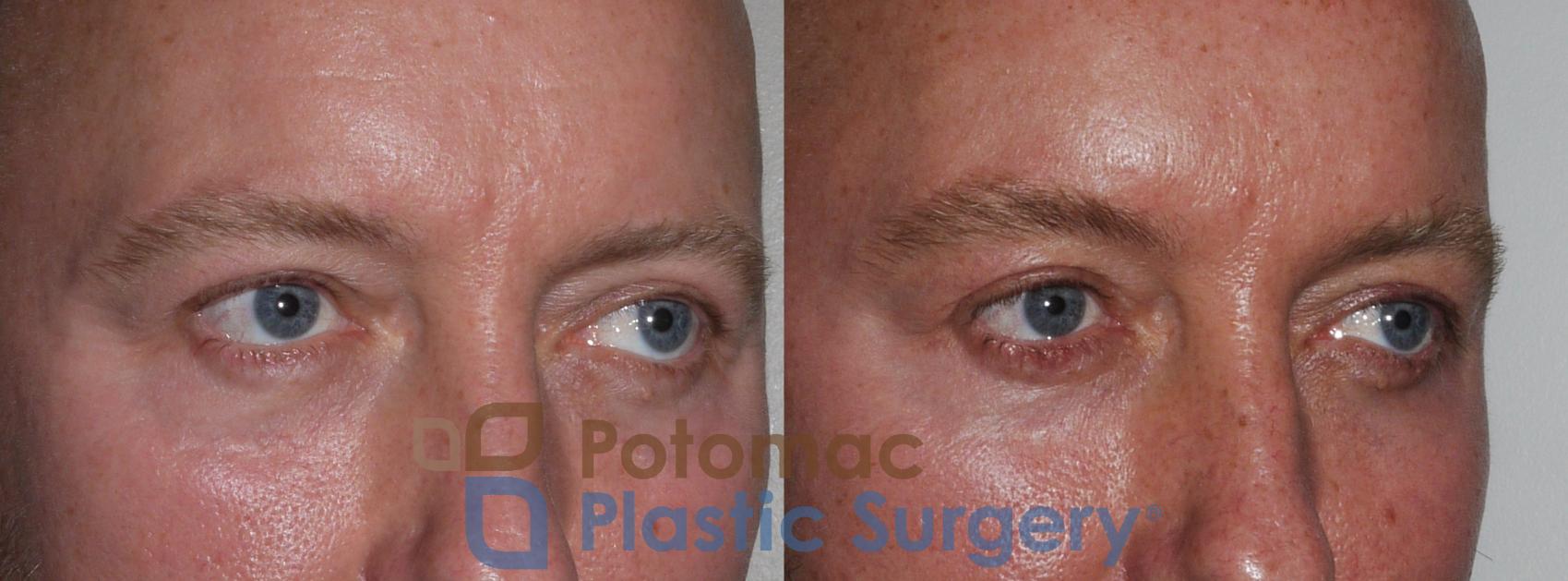 Before & After Blepharoplasty Case 178 Right Oblique View in Washington, DC