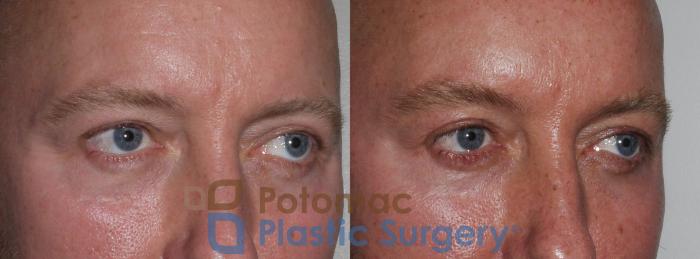 Before & After Blepharoplasty Case 178 Right Oblique View in Washington DC & Arlington , DC