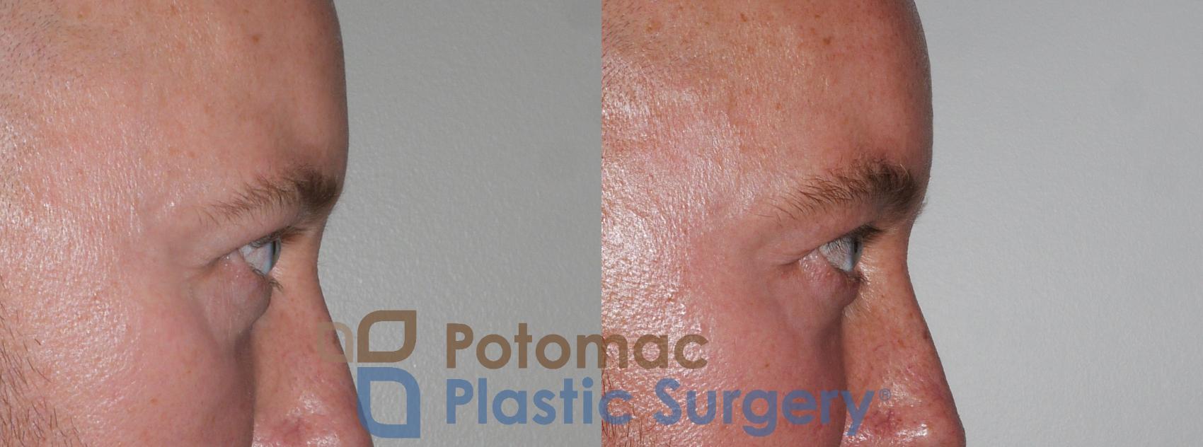 Before & After Blepharoplasty Case 178 Right Side View in Washington, DC