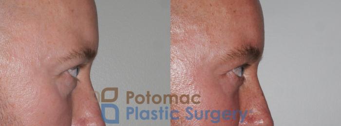 Before & After Blepharoplasty Case 178 Right Side View in Washington DC & Arlington , DC