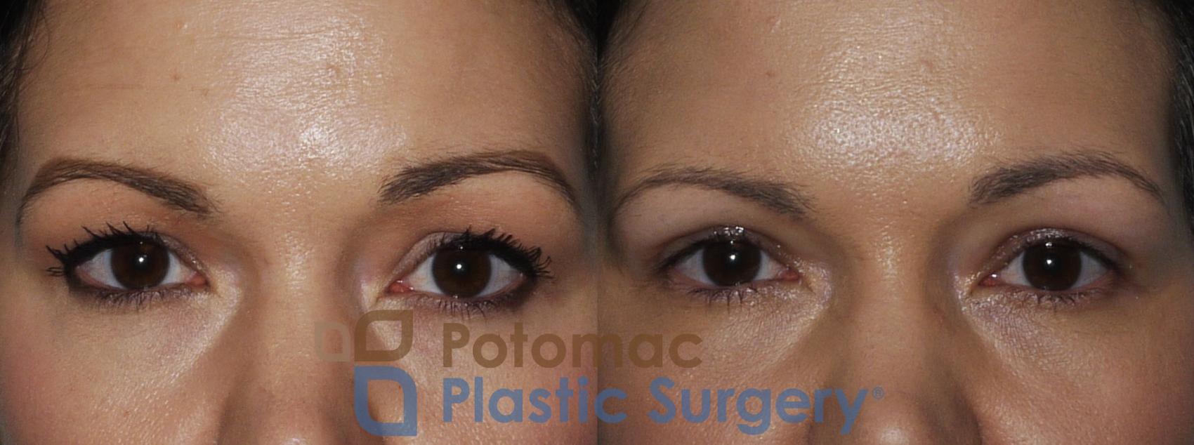 Before & After Blepharoplasty Case 199 Front View #1 View in Washington DC & Arlington , DC