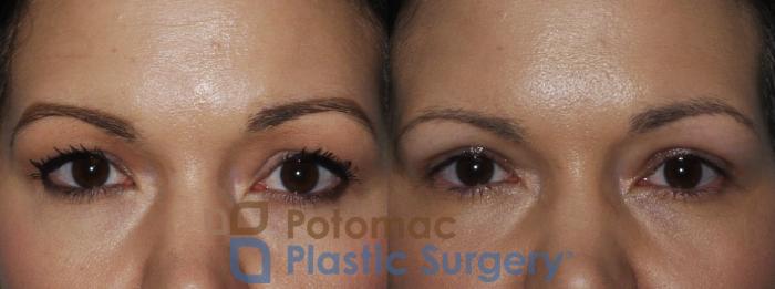 Before & After Blepharoplasty Case 199 Front View #1 View in Washington DC & Arlington , DC