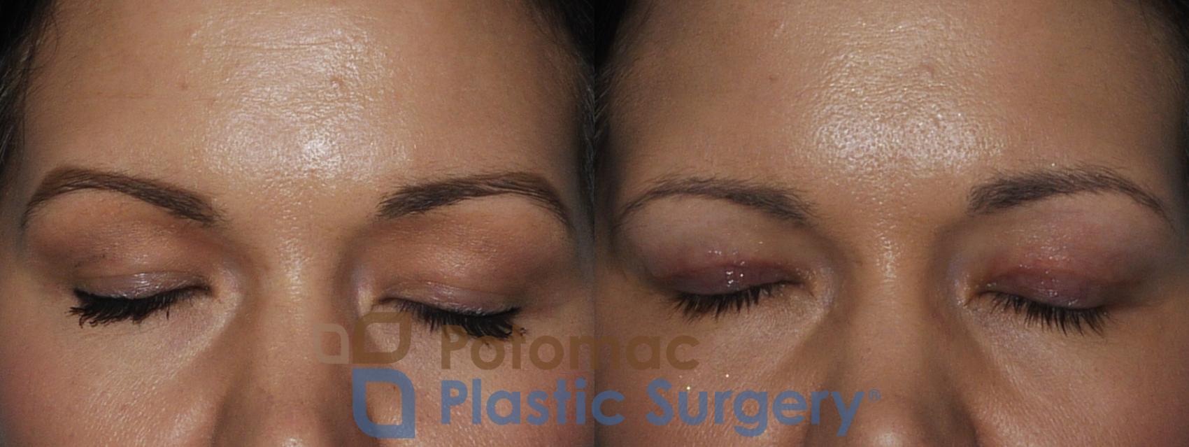 Before & After Liquid Facelift Case 199 Front View #2 View in Washington DC & Arlington , DC
