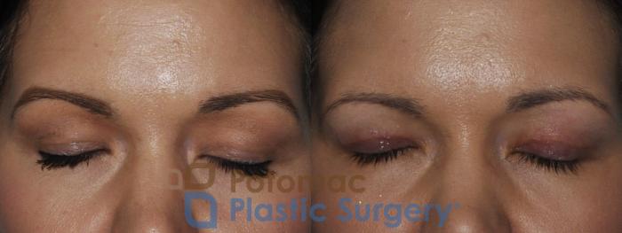 Before & After Liquid Facelift Case 199 Front View #2 View in Washington DC & Arlington , DC