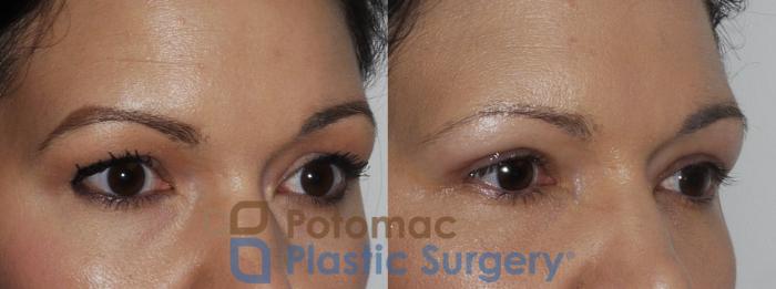 Before & After Blepharoplasty Case 199 Right Oblique View in Washington DC & Arlington , DC