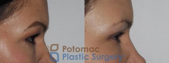 Before & After Blepharoplasty Case 199 Right Side View in Washington DC & Arlington , DC