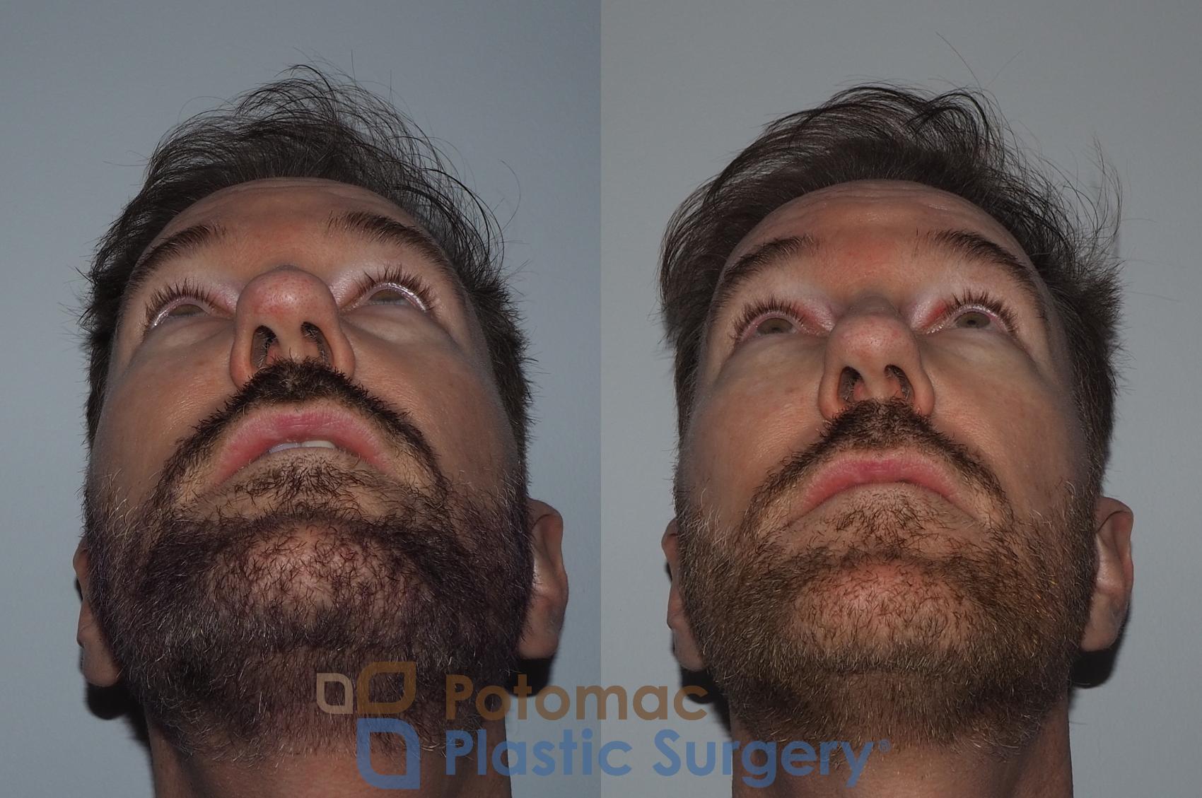 Before & After Blepharoplasty Case 215 Bottom View in Washington, DC