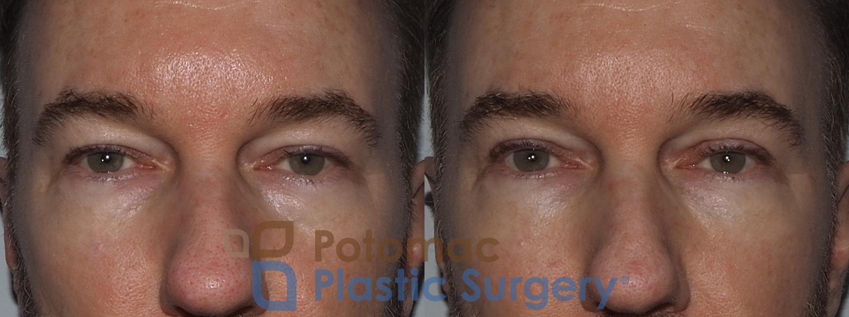 Before & After Blepharoplasty Case 215 Front View in Washington, DC