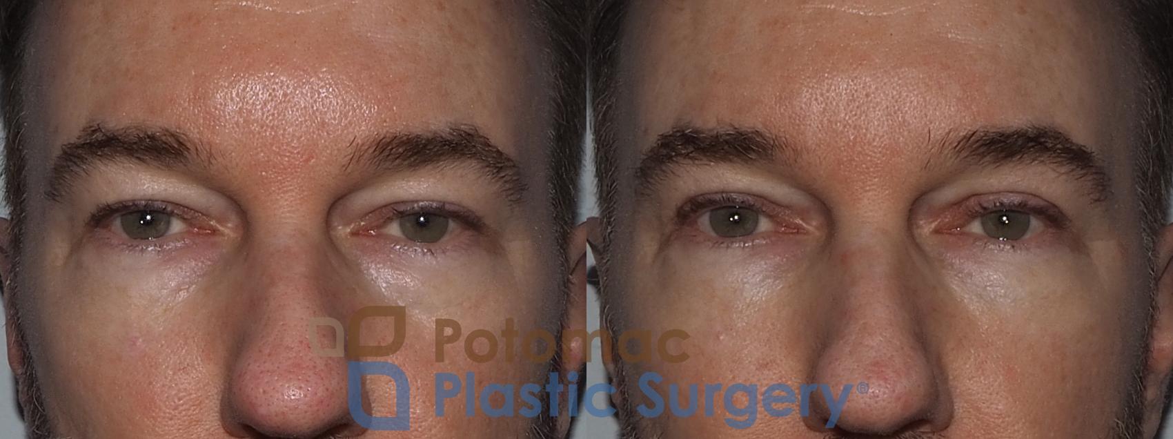 Upper Blepharoplasty With Under Eye Fillers To Rejuvenate The Appearance Of A Middle Aged Man