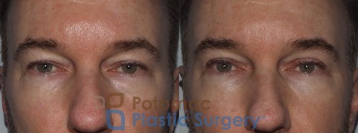 Before & After Blepharoplasty Case 215 Front View in Washington, DC
