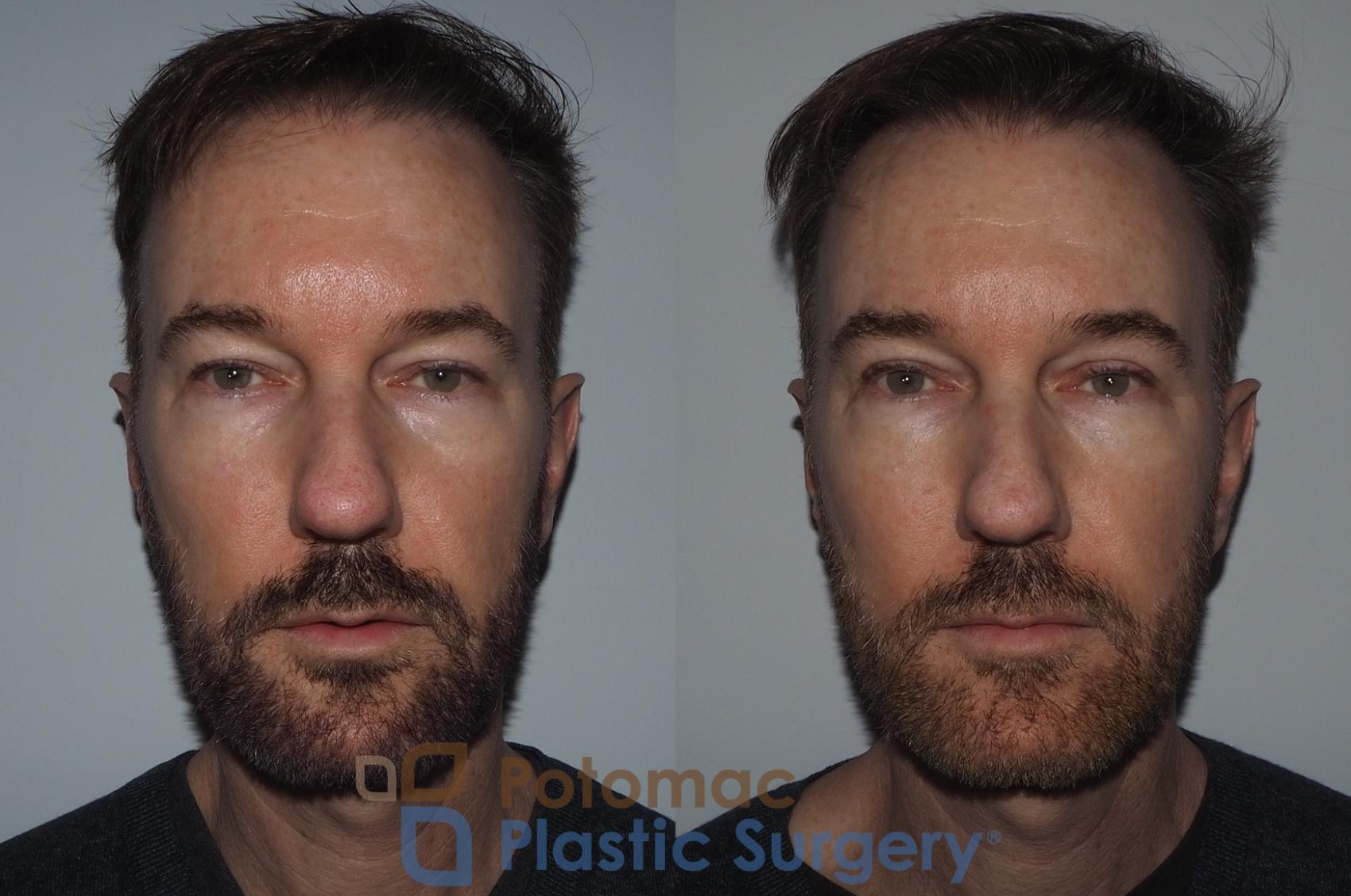 Before & After Blepharoplasty (Eyelid Surgery) Case 215 Front View #2 View in Washington DC & Arlington , DC