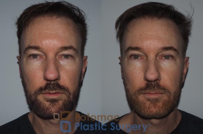 Before & After Dermal Fillers Case 215 Front View #2 View in Washington DC & Arlington , DC