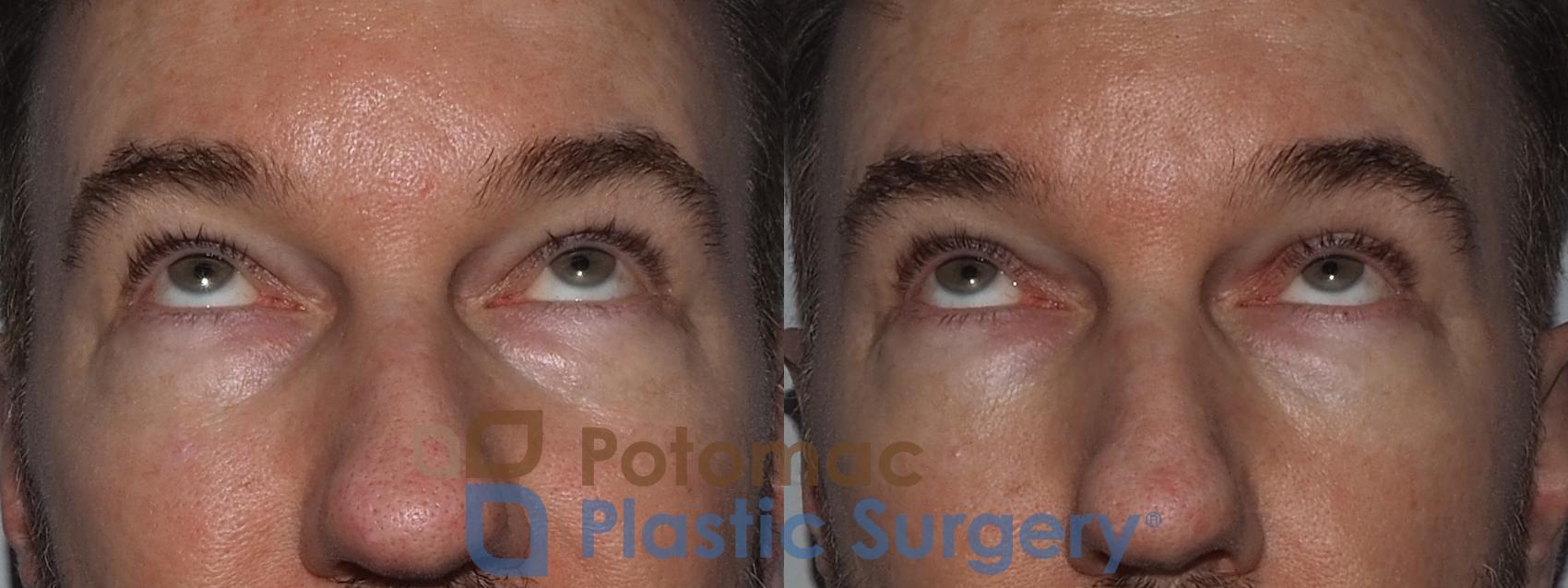 Before & After Blepharoplasty Case 215 Front View #3 View in Washington, DC