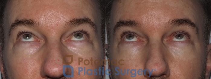 Before & After Dermal Fillers Case 215 Front View #3 View in Washington DC & Arlington , DC