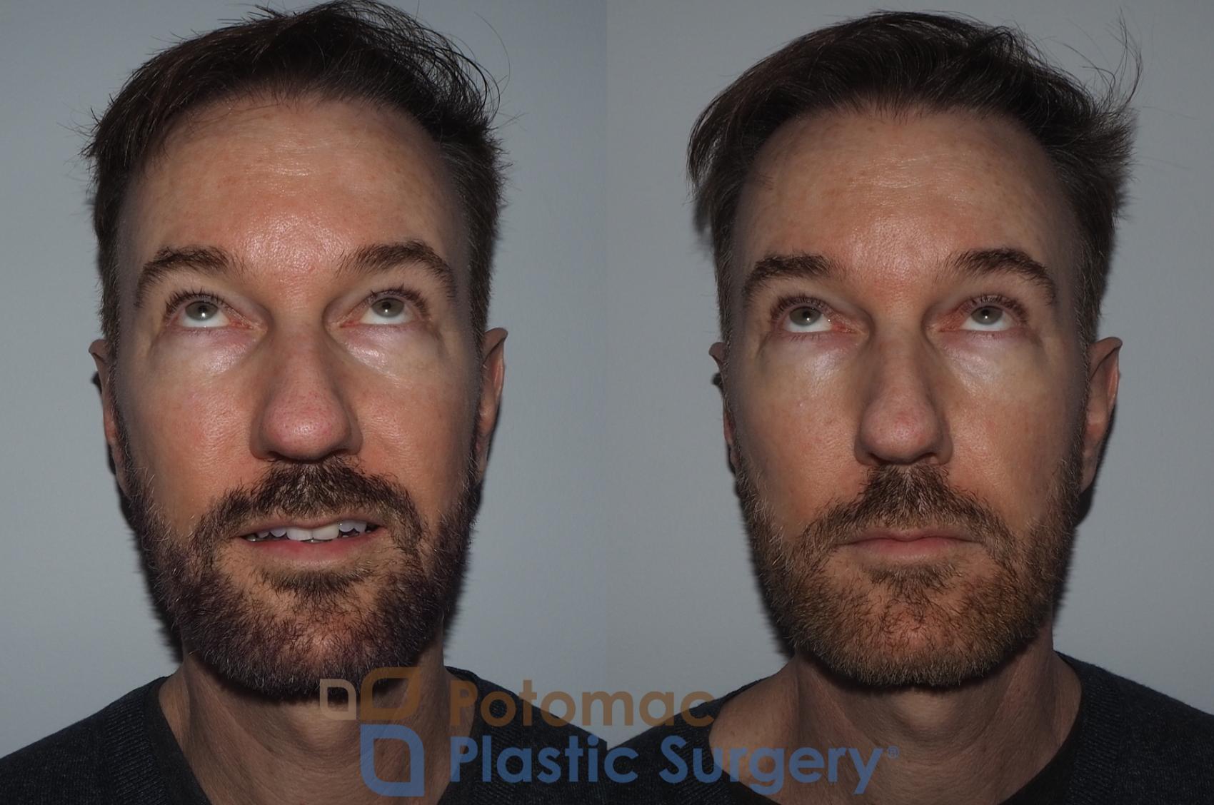 Before & After Blepharoplasty Case 215 Front View #4 View in Washington, DC