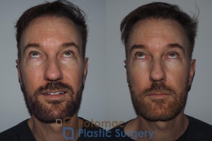 Before & After Liquid Facelift Case 215 Front View #4 View in Washington DC & Arlington , DC
