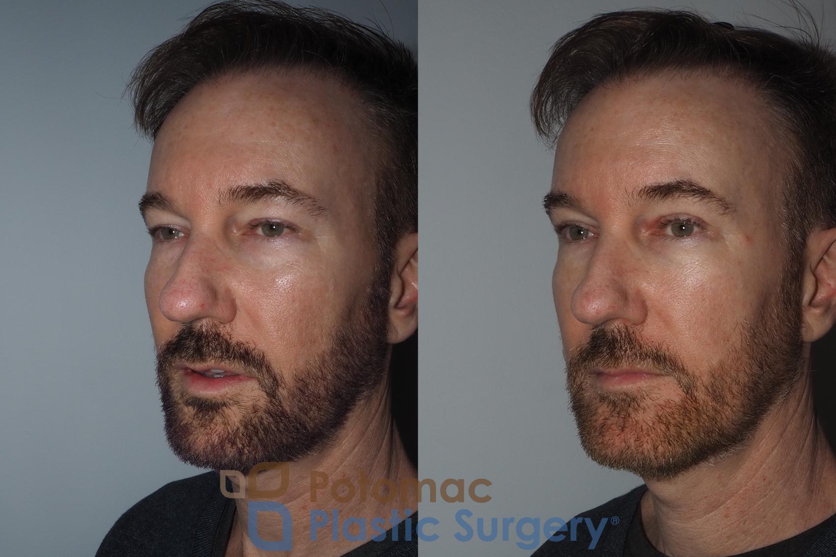 Before & After Blepharoplasty Case 215 Left Oblique View in Washington, DC