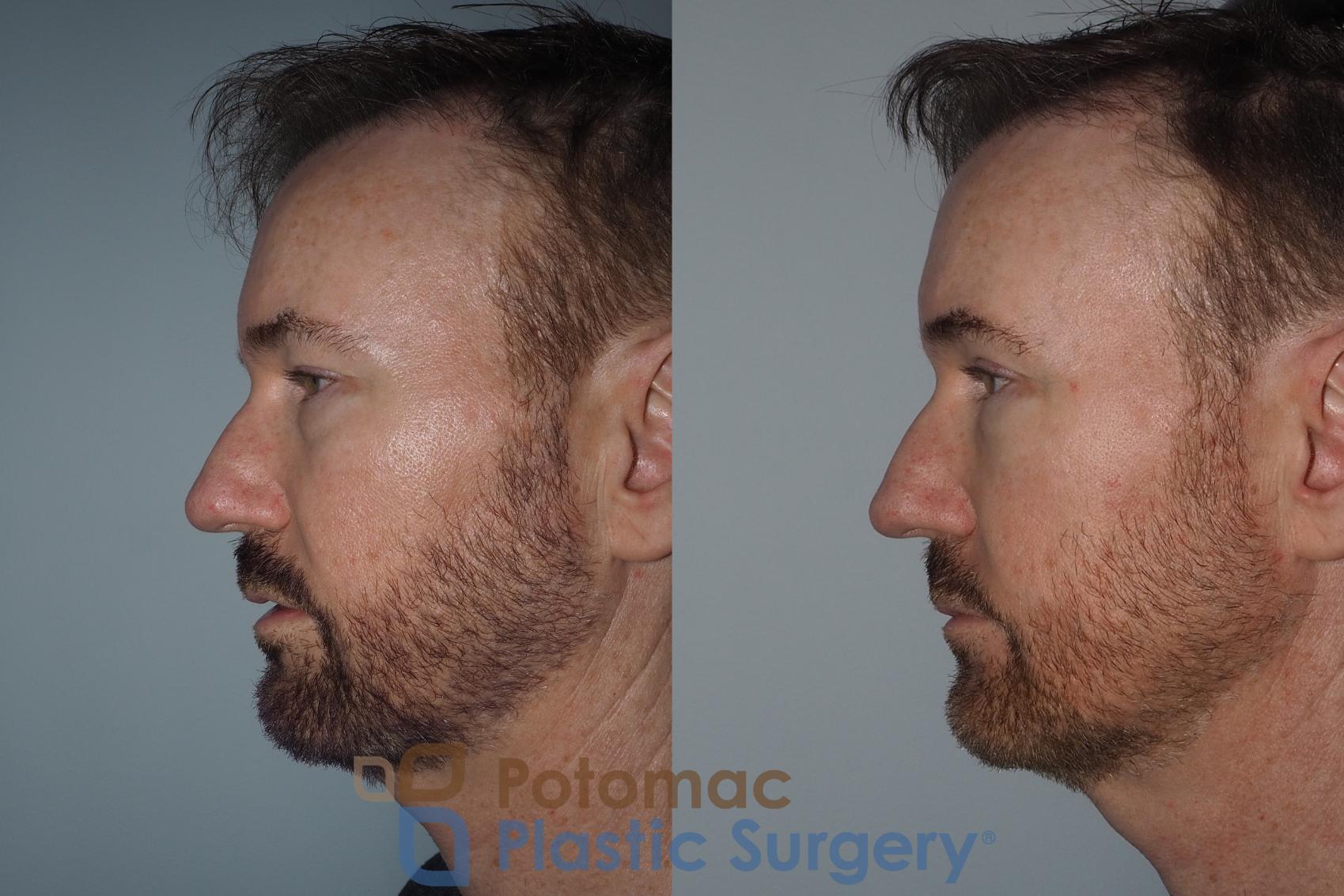 Before & After Blepharoplasty Case 215 Left Side View in Washington, DC