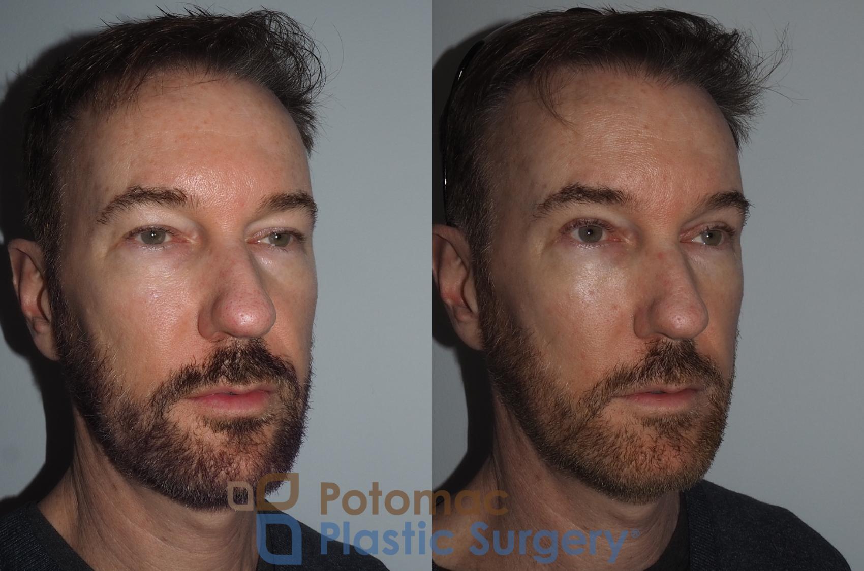 Before & After Blepharoplasty Case 215 Right Oblique View in Washington, DC