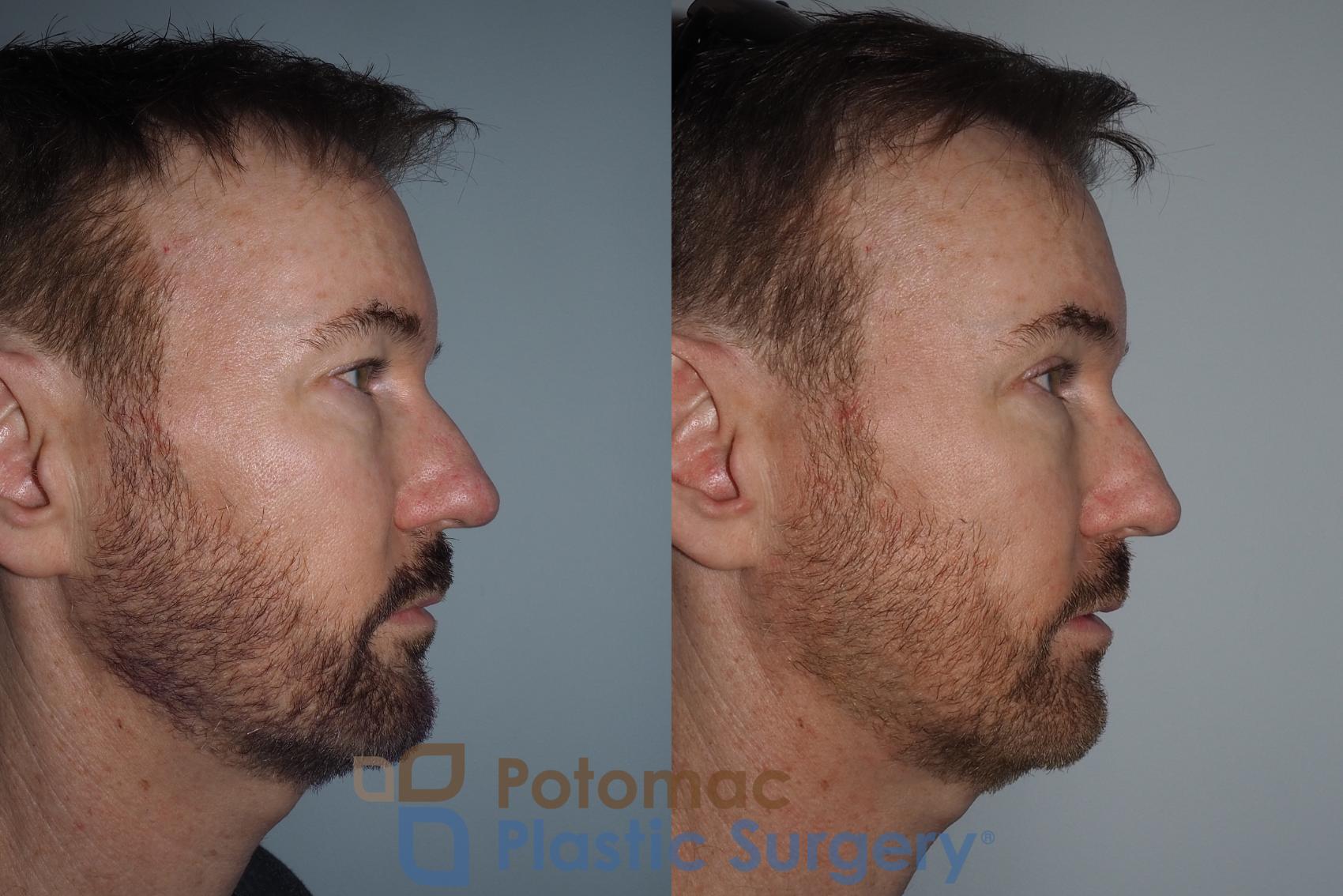 Before & After Blepharoplasty Case 215 Right Side View in Washington, DC
