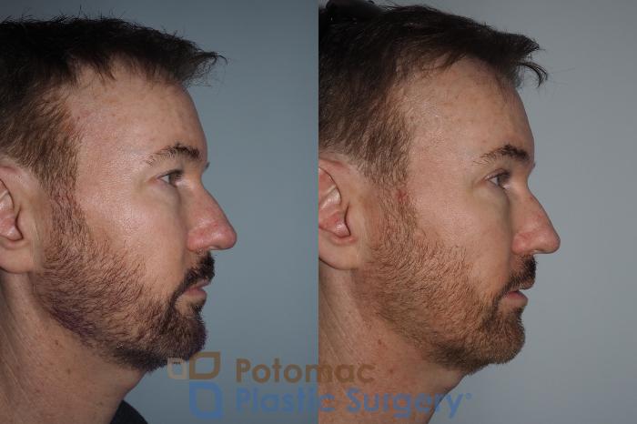Before & After For Men Case 215 Right Side View in Washington DC & Arlington , DC