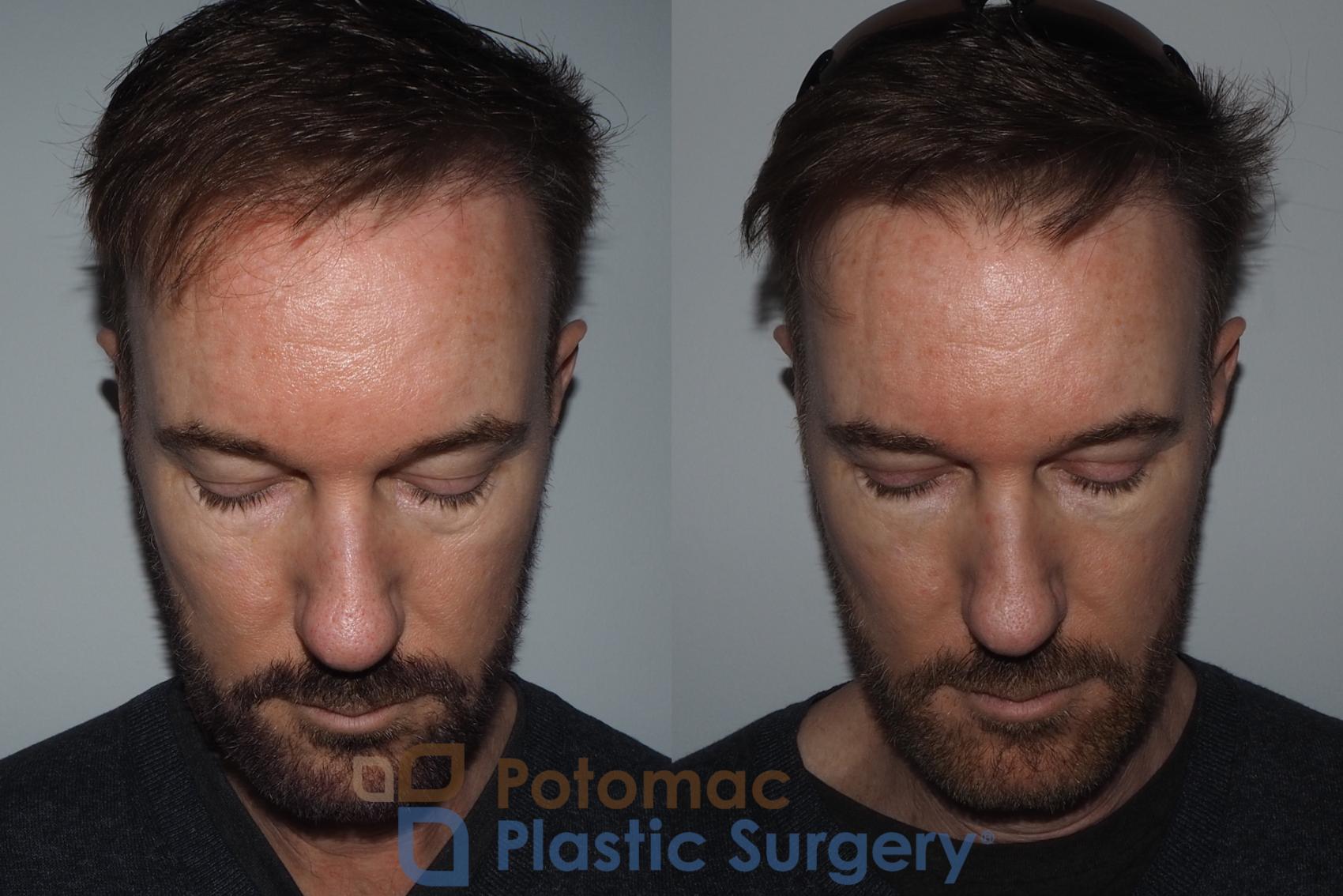 Before & After Blepharoplasty Case 215 Top View in Washington, DC